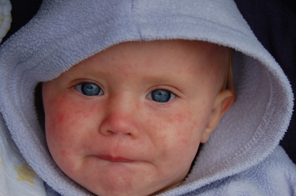 Multiple measles outbreaks affecting children and adults
